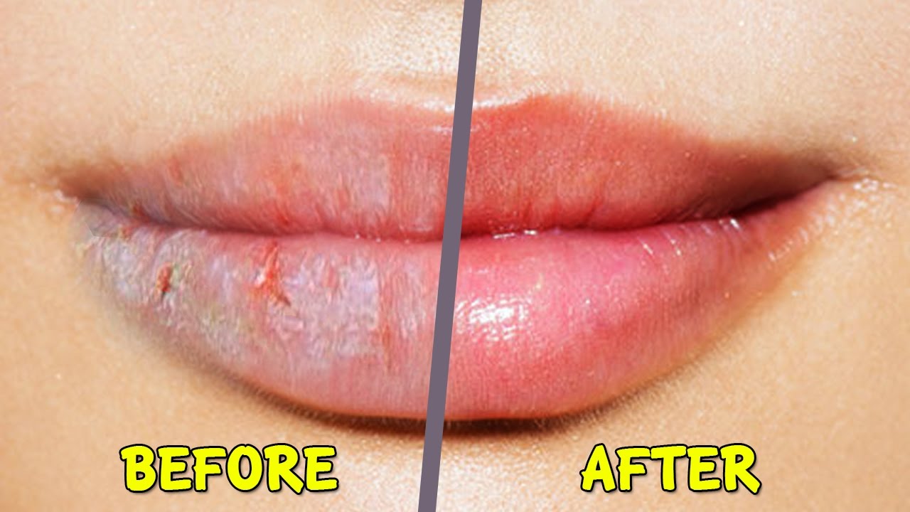 how-chapped-lips-could-be-caused-by-dry-skin-expert-advice-allure