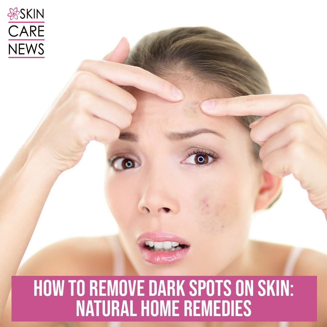 How To Remove Dark spots On Skin: Natural Home Remedies - Skin Care Top ...