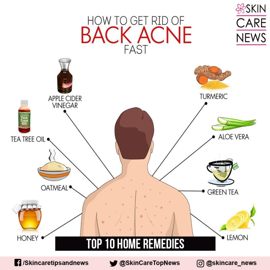 how-to-get-rid-of-back-acne-fast-skin-care-top-news