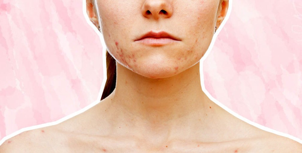 This Pill Could Finally Get Rid Of Hormonal Acne Skin Care Top News