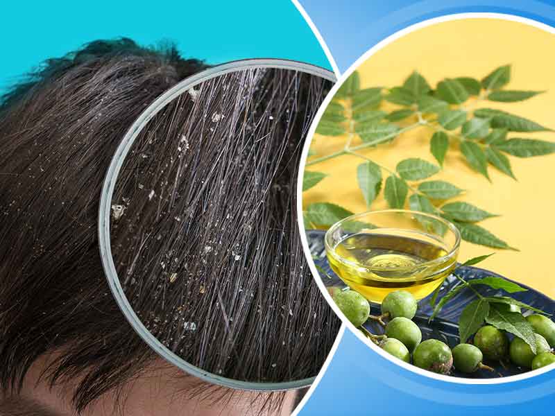 dandruff-using-neem-at-home-skin-care-top-news