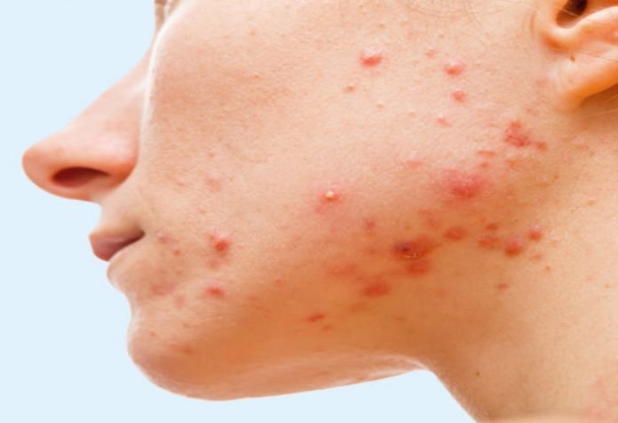 Say BYE-BYE to Cystic Acne Your concerns about how to prevent cystic