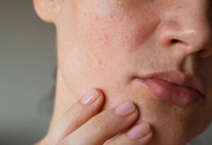Open Skin Pores Reduce with home Remedies: Skin Care Top News