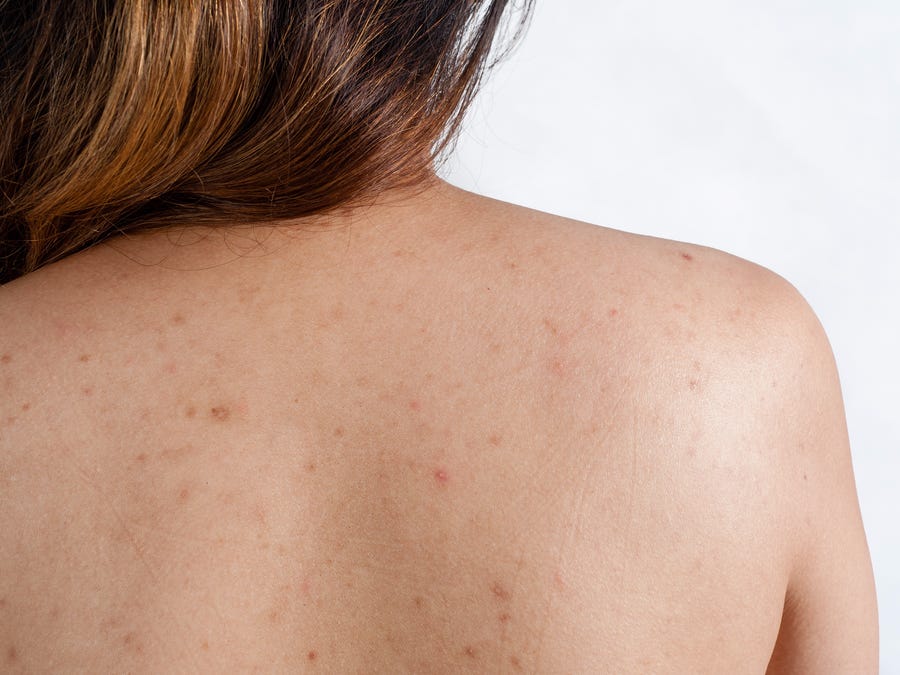 Back Acne reasons and how you can prevent it Naturally