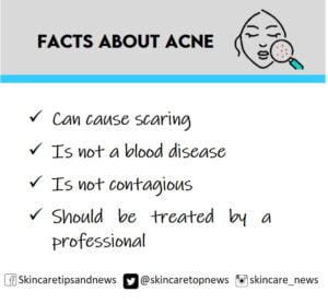 Facts about acne Facts about acne that are sometimes unknown to people