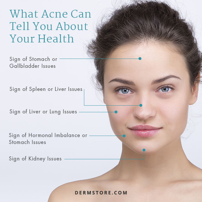 What Your Acne Might Be Telling You About Your Health