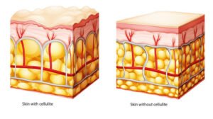Cellulitis