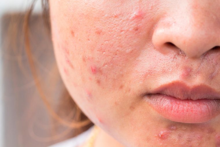 What Are Those Red Marks That Appear After My Breakouts?