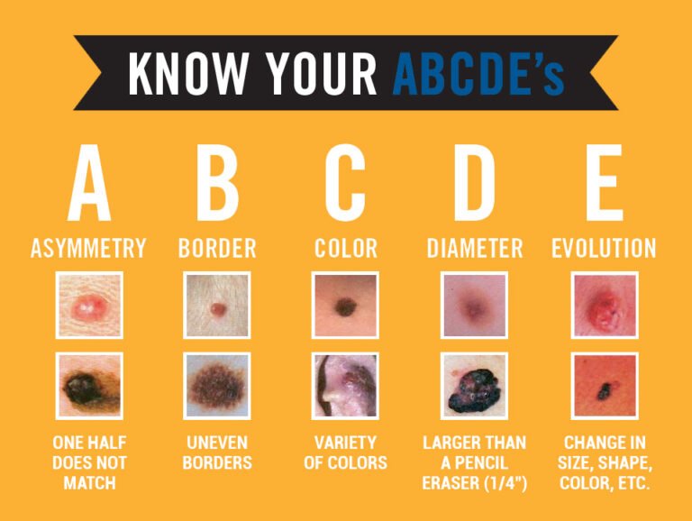 Mole Chart For Skin Cancer Detection 768x578 