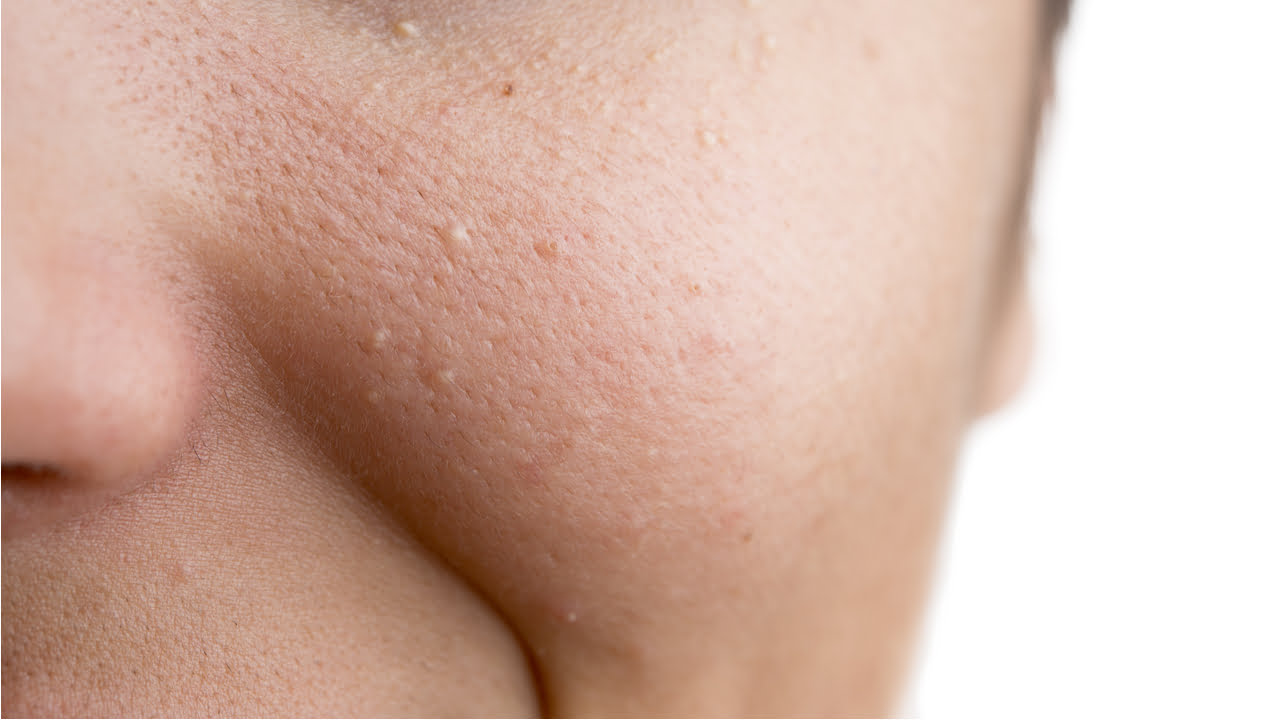 What Are Those Tiny Bumps On Your Face 5 Possibilities