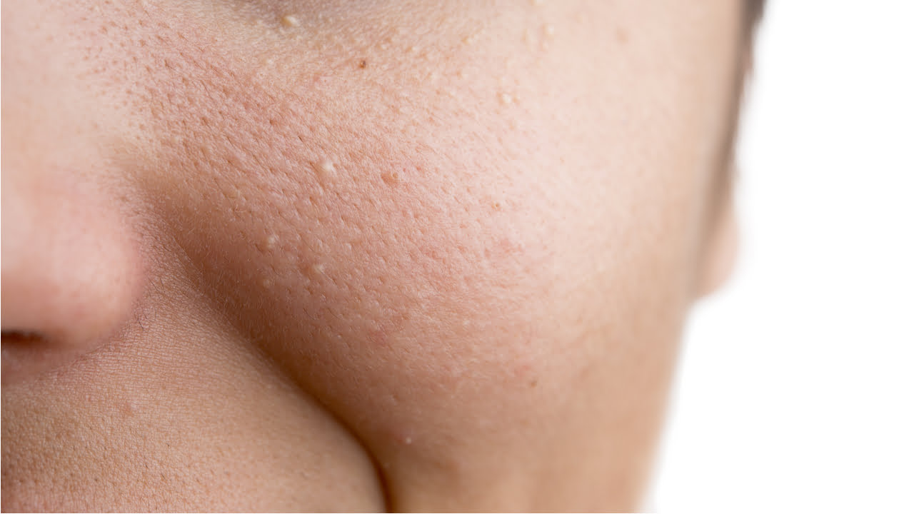 what-are-those-tiny-bumps-on-your-face-5-possibilities