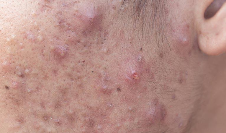 11 Home Remedies for Cystic Acne If you've ever suffered from cystic