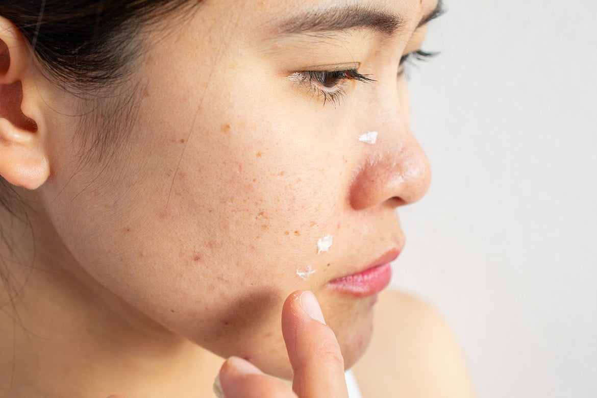 Homemade Face Moisturizer For Acne Prone Skin
