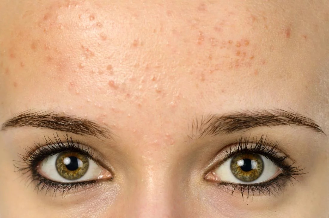Zap Your Zits: How to Treat Hormonal Acne How to Get Rid of Forehead Acne Naturally?