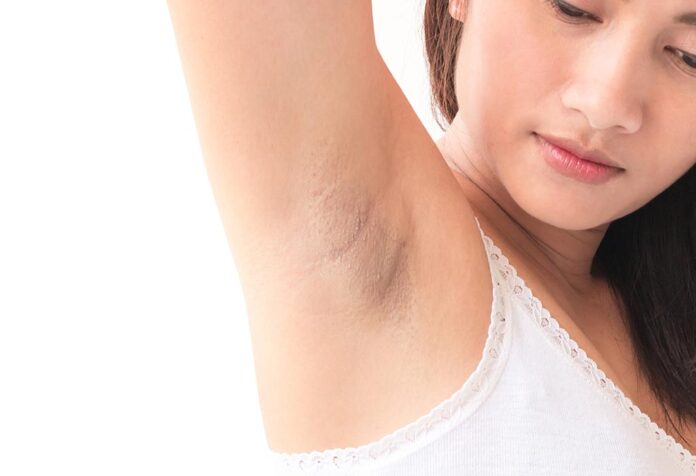 HOME REMEDIES FOR DARK UNDERARMS