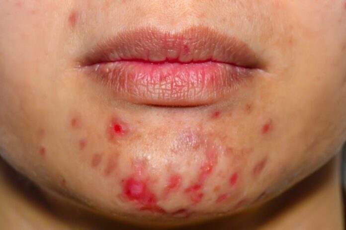 How to Treat Different Types of Acne