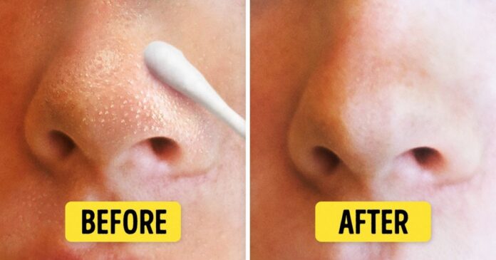 12 Ways to Get Rid of Whiteheads and get clean skin