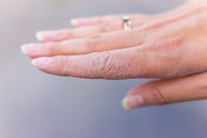 HOW TO REMOVE THE DRYNESS OF YOUR SKIN?