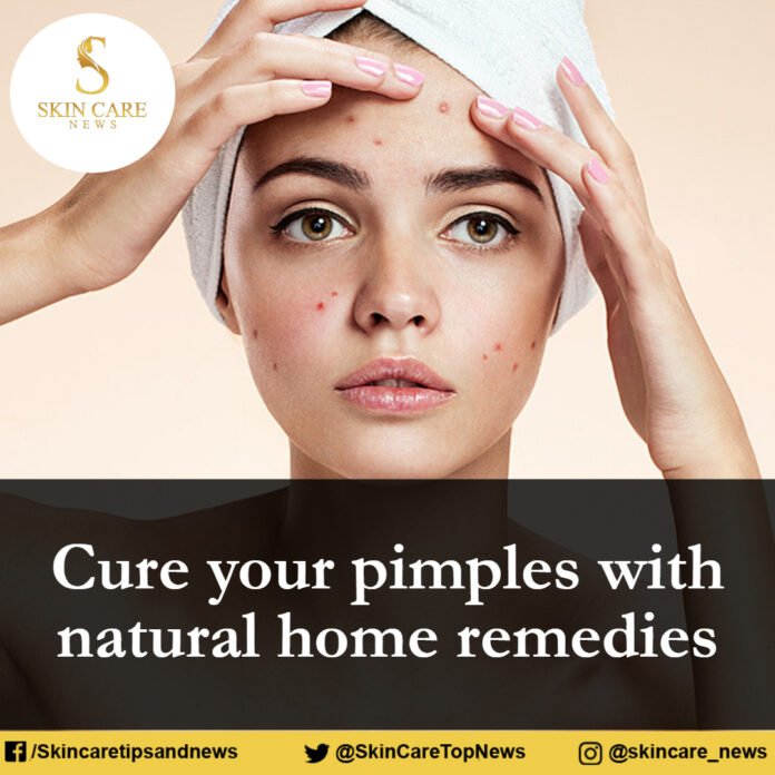 Cure your pimples with natural home remedies