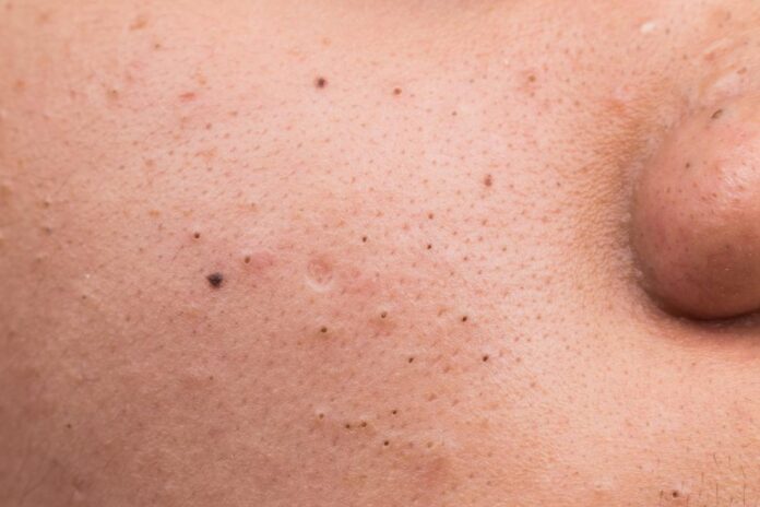 Regain Your Flawless Skin with These DIY Blackhead Mask for Clean and Clear Skin!