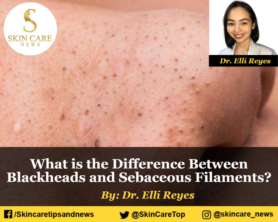 What is the Difference Between Blackheads and Sebaceous Filaments?