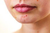Cure your pimples with natural home remedies