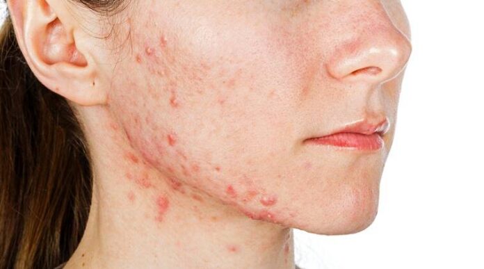 Salicylic acid- a right choice for acne-prone skin