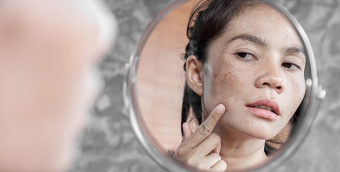 MELASMA: Who Gets, Symptoms, Causes, Diagnosis and Treatment