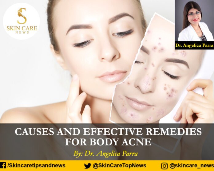 CAUSES AND EFFECTIVE REMEDIES FOR BODY ACNE