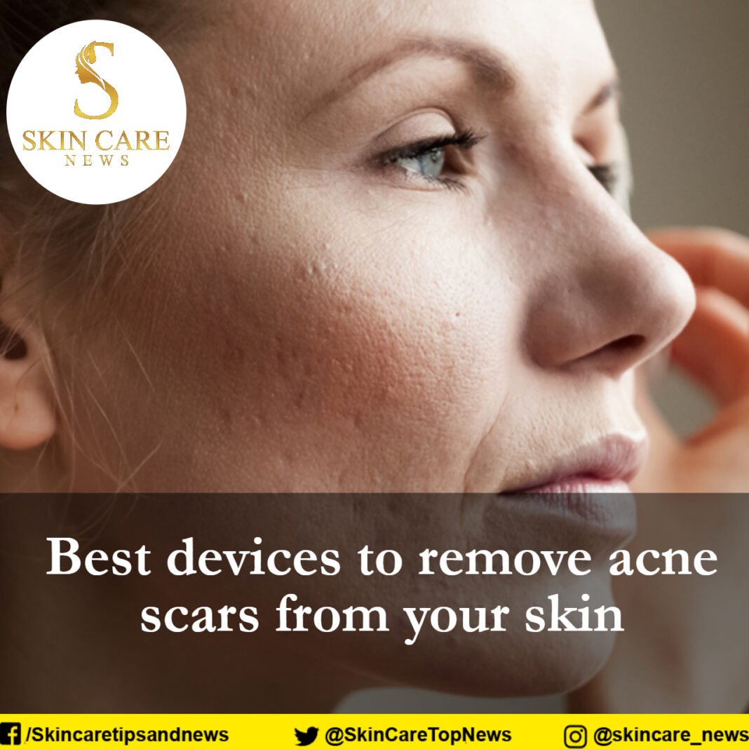 Best devices to remove acne scars from your skin.................