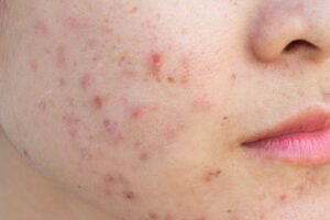 Look these simple homemade tips on how do you treat scars at home?