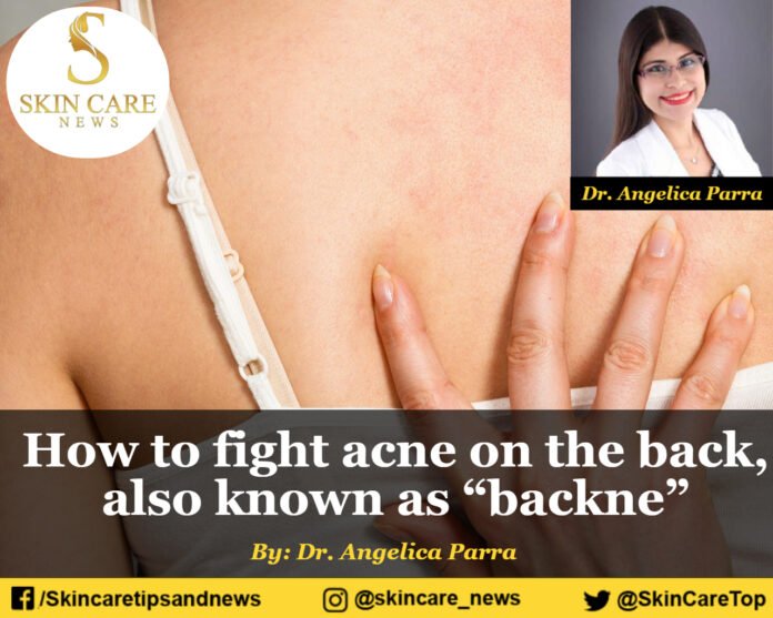 How to fight acne on the back, also known as “backne”