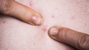 Everything you should know about teenage acne