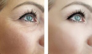 Remove your wrinkles and fine lines with a wrinkle reducer