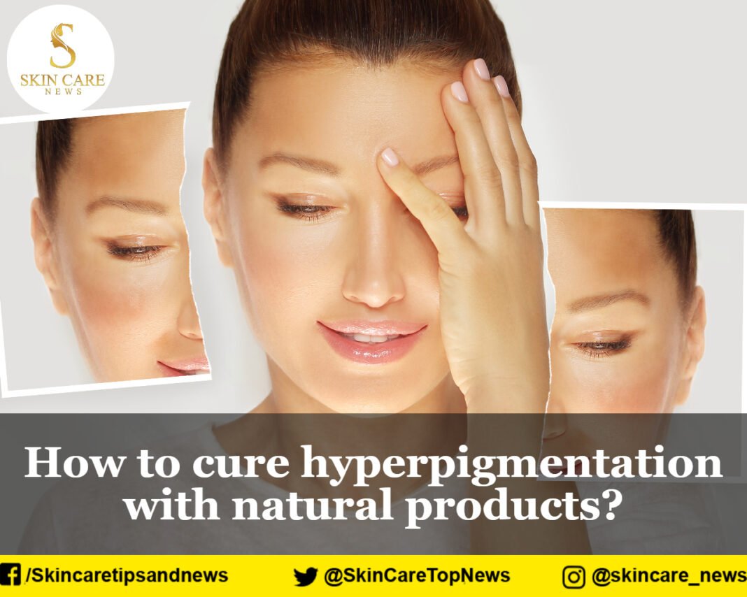 How to cure hyperpigmentation with natural products?