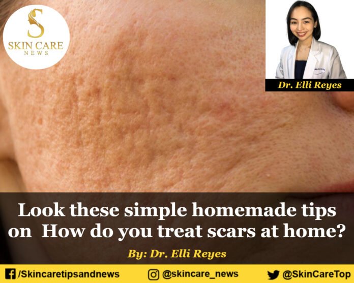 Look these simple homemade tips on how do you treat scars at home?