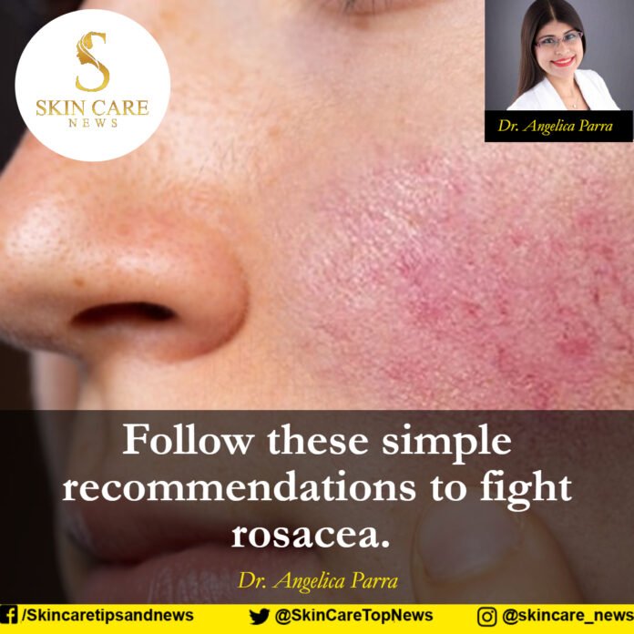 Follow these simple recommendations to fight rosacea.