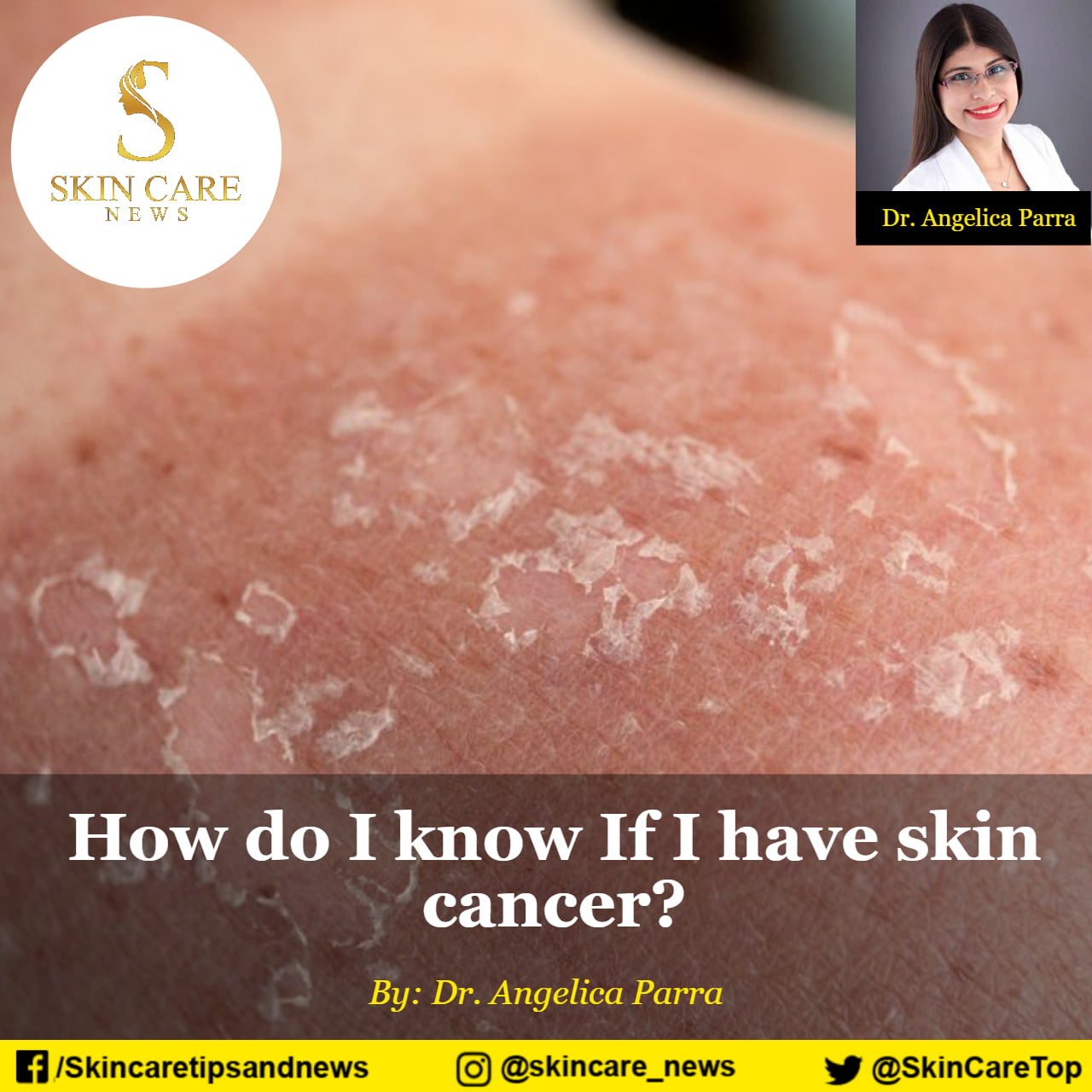 how-do-i-know-if-i-have-skin-cancer-skincare-news