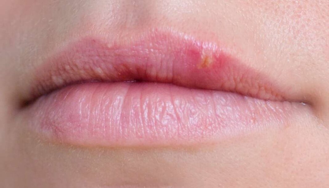 what-are-these-white-dots-known-as-fordyce-spots-on-my-lips