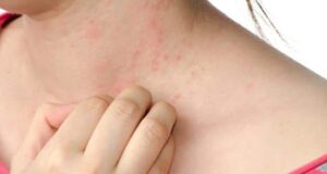 Furfuryl Palmitate: A Novel Antioxidant for Red and Itchy Skin 