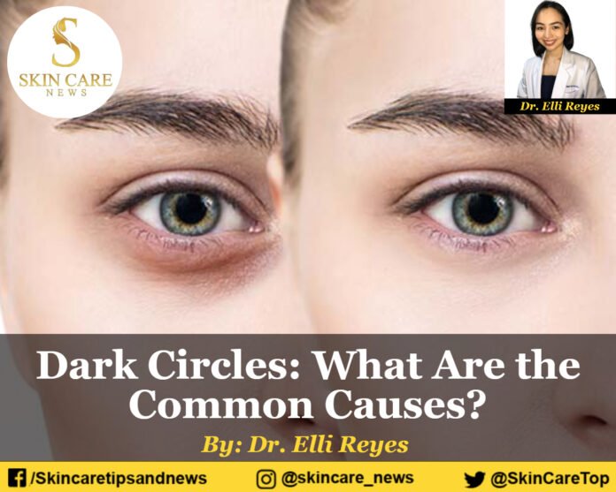 Dark Circles: What Are the Common Causes?