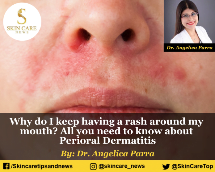 Why do I keep having a rash around my mouth? All you need to know about Perioral Dermatitis