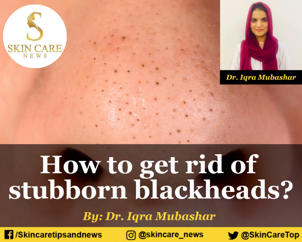 How to get rid of stubborn blackheads on nose and face?
