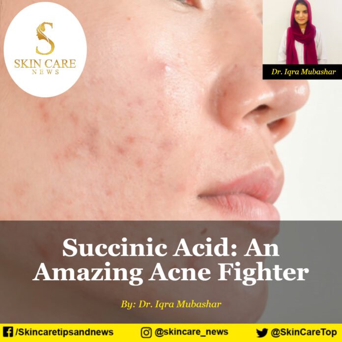 Succinic Acid An Amazing Acne Fighter