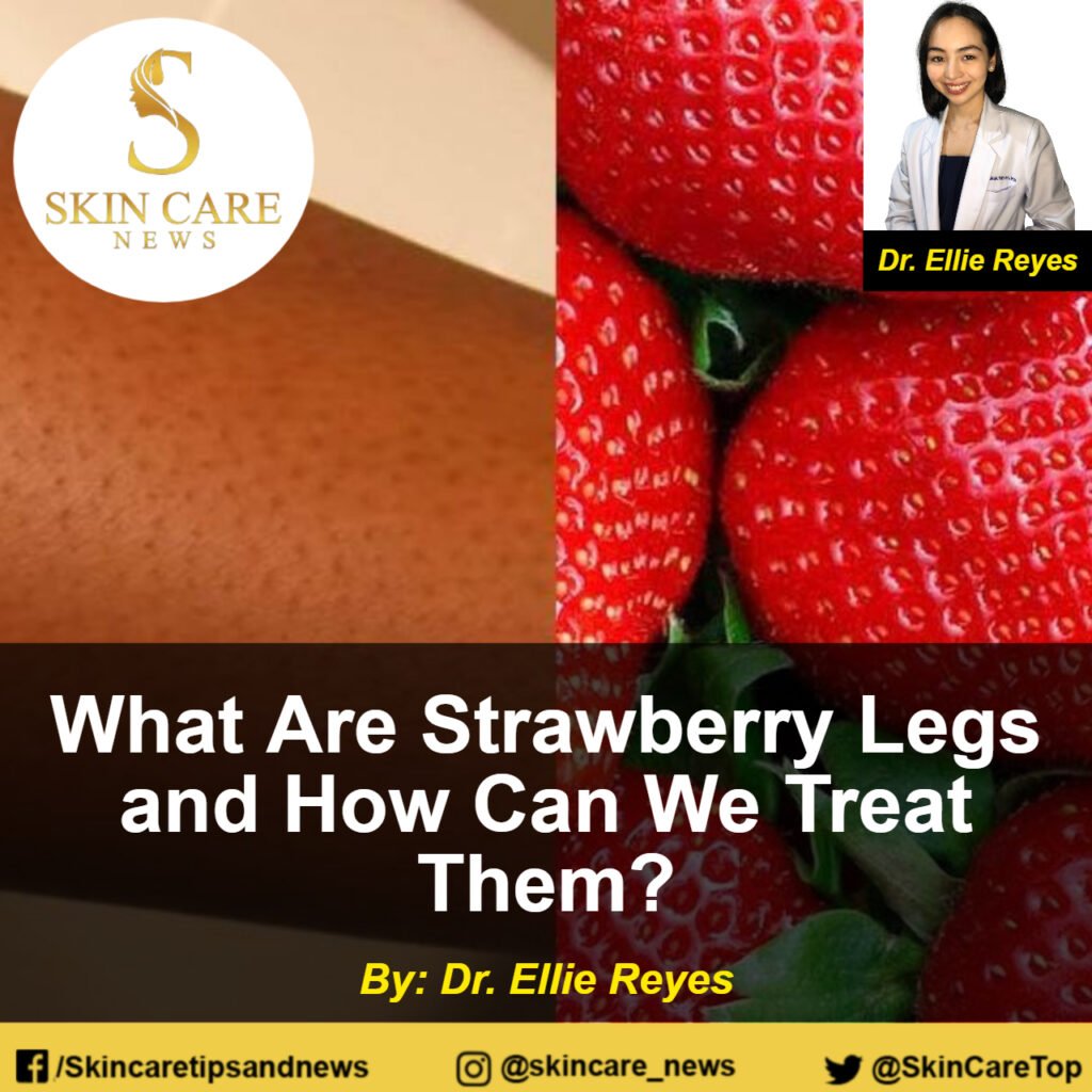What Are Strawberry Legs and How Can We Treat Them?