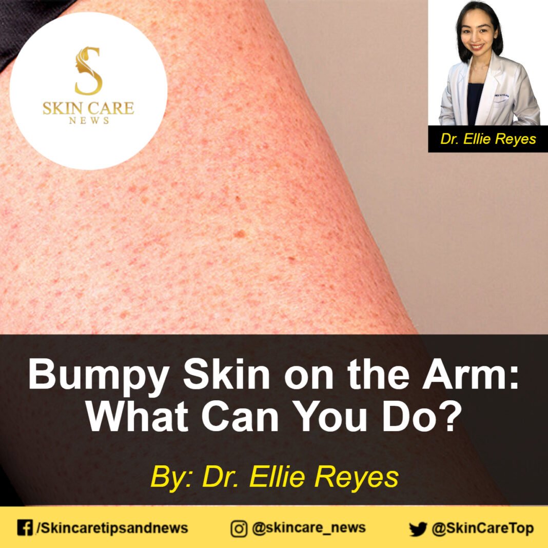 Bumpy Skin on the Arm What Can You Do for soft skin