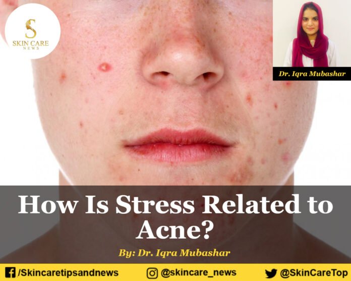 How is stress related to acne?