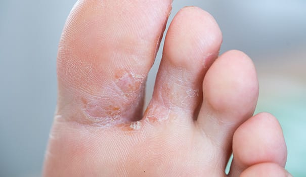 How to Avoid Skin Fungal Infections in Summers?