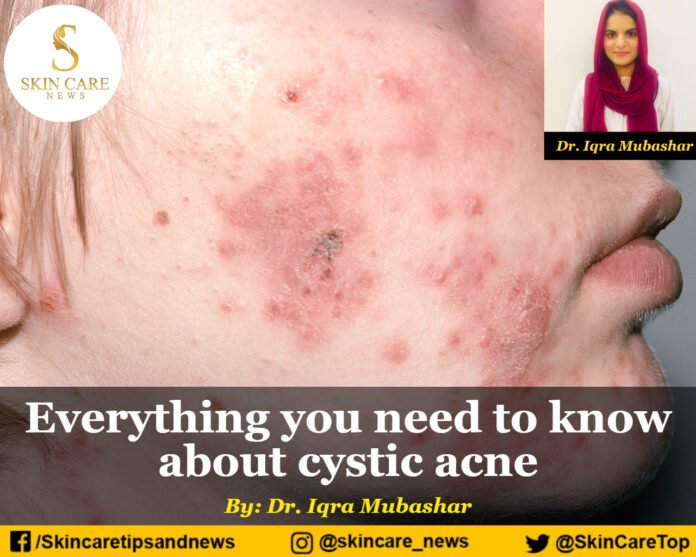 Everything you need to know about cystic acne