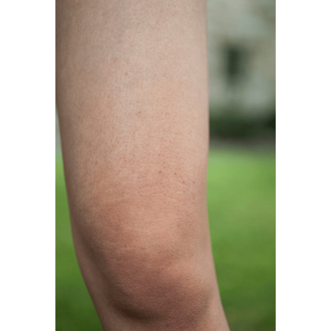 Bumpy Skin on the Arm What Can You Do for soft skin